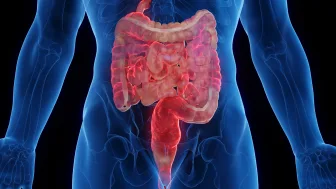 Il microbiota tra le cause del morbo di Crohn?
