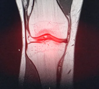 Il liquido sinoviale ha un legame complesso con l’artrite