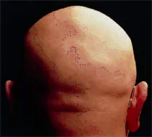 Trovata per caso una cura per l'alopecia?