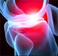 Cartilagine biotech contro l'osteoartrite